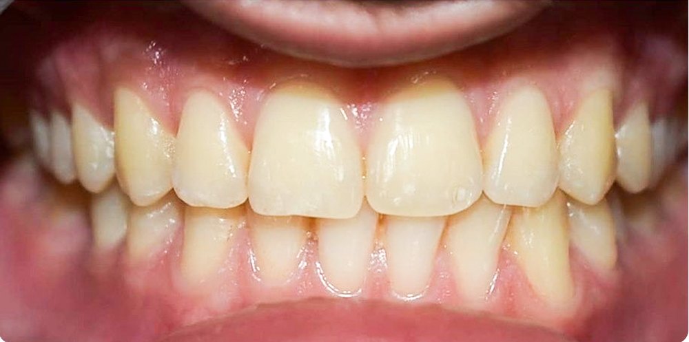 After: midline diastema closed, front teeth evenly aligned