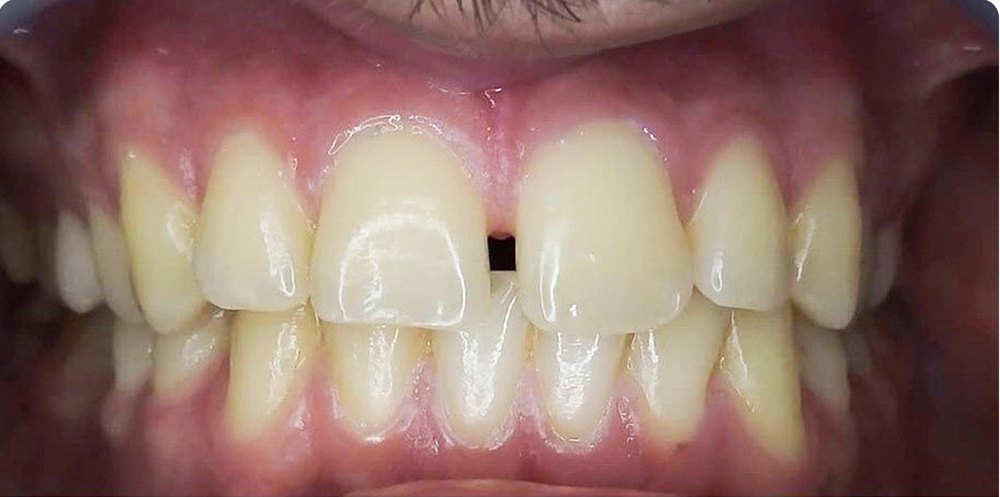 Before: gap between the upper front teeth (midline diastema)